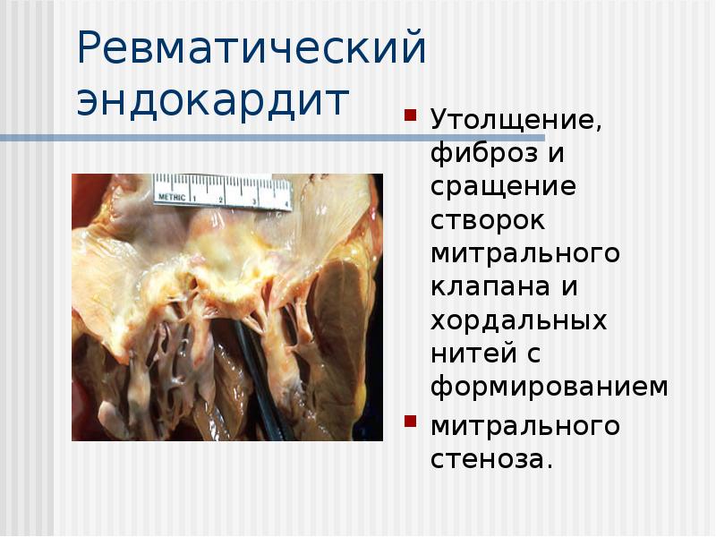 Ревматический эндокардит
Утолщение, фиброз и сращение створок митрального клапана и Ревматический эндокардит
Утолщение, фиброз и сращение створок митрального клапана и