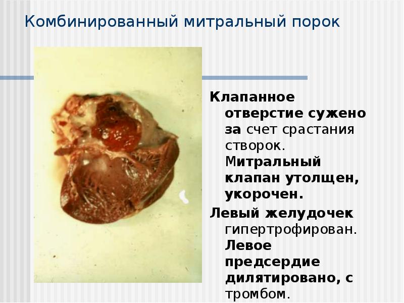 Комбинированный митральный порок
Клапанное отверстие сужено за счет срастания створок. Комбинированный митральный порок
Клапанное отверстие сужено за счет срастания створок.