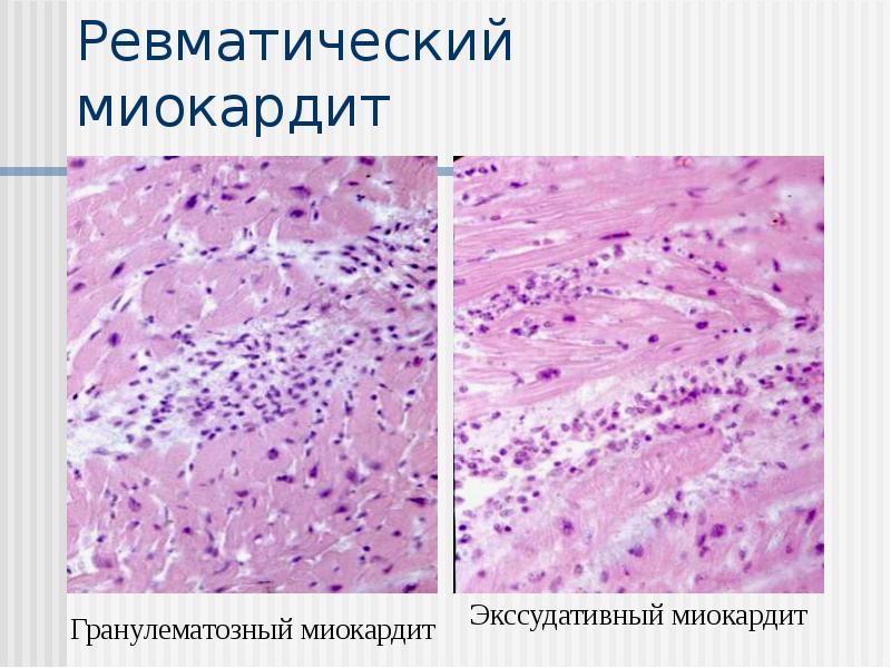 Ревматический миокардит Ревматический миокардит