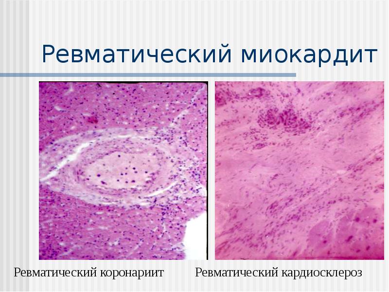 Ревматический миокардит Ревматический миокардит