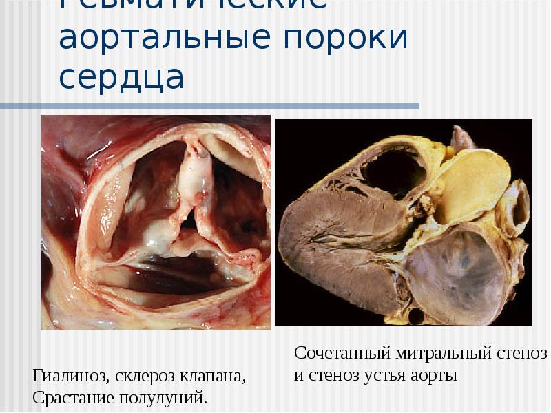 Ревматические аортальные пороки сердца Ревматические аортальные пороки сердца