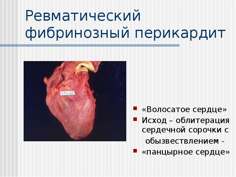 Ревматический фибринозный перикардит
«Волосатое сердце»
Исход – облитерация сердечной сорочки Ревматический фибринозный перикардит
«Волосатое сердце»
Исход – облитерация сердечной сорочки