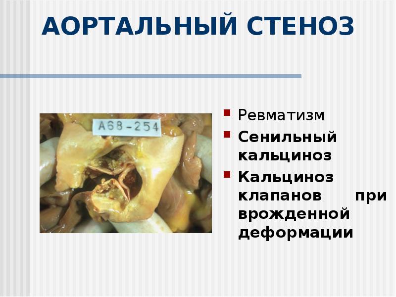 АОРТАЛЬНЫЙ СТЕНОЗ
Ревматизм
Сенильный кальциноз
Кальциноз клапанов при АОРТАЛЬНЫЙ СТЕНОЗ
Ревматизм
Сенильный кальциноз
Кальциноз клапанов при