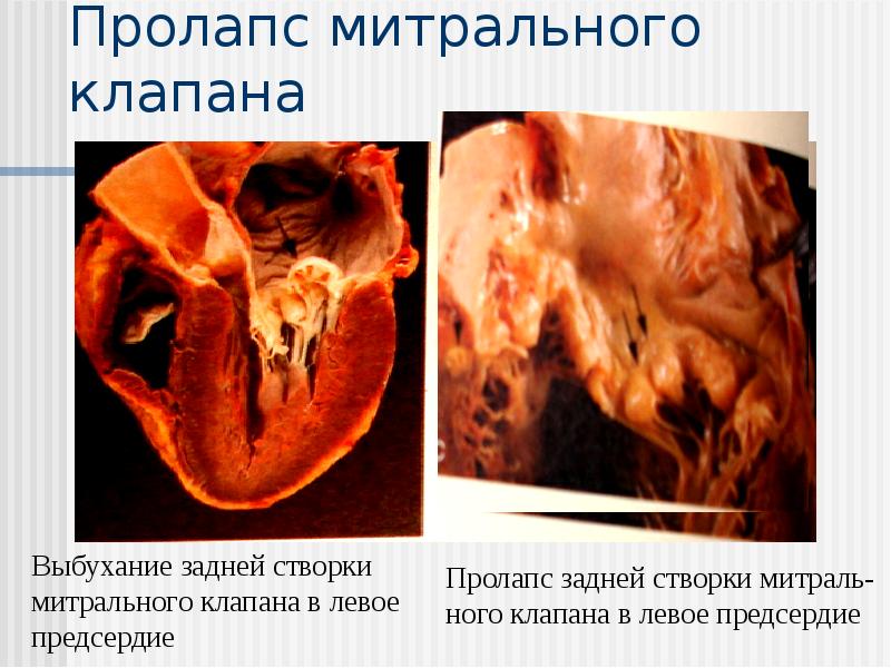 Пролапс митрального клапана Пролапс митрального клапана