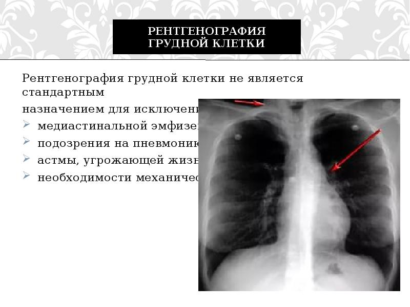 Бронхиальная астма рентгенологическая картина