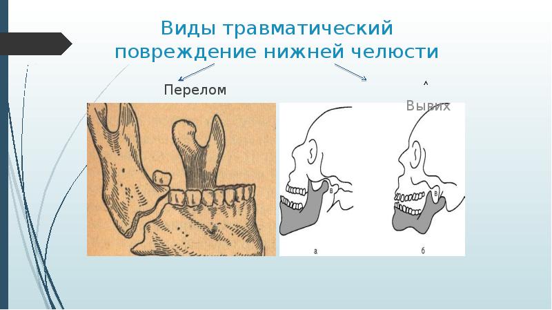 Перелом челюсти карта вызова