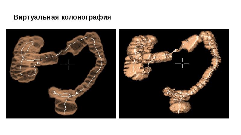 Кт картина долихосигмы это