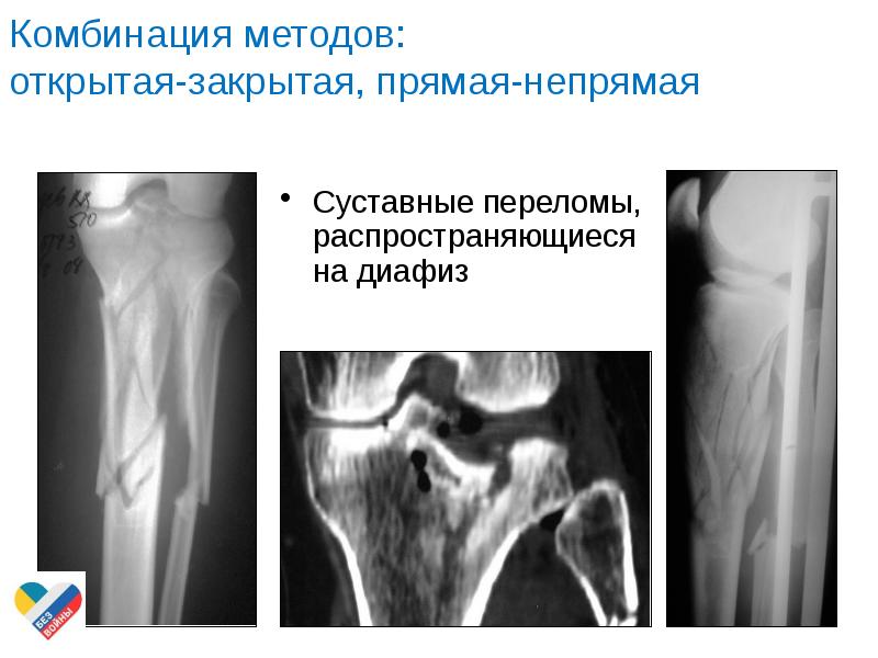 Прямая и непрямая репозиция. Прямые и непрямые переломы.