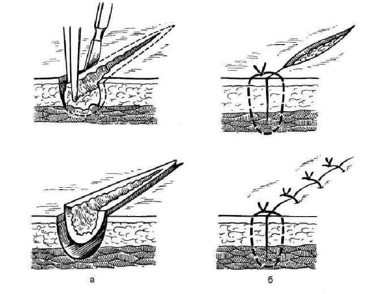 Схема хирургических швов