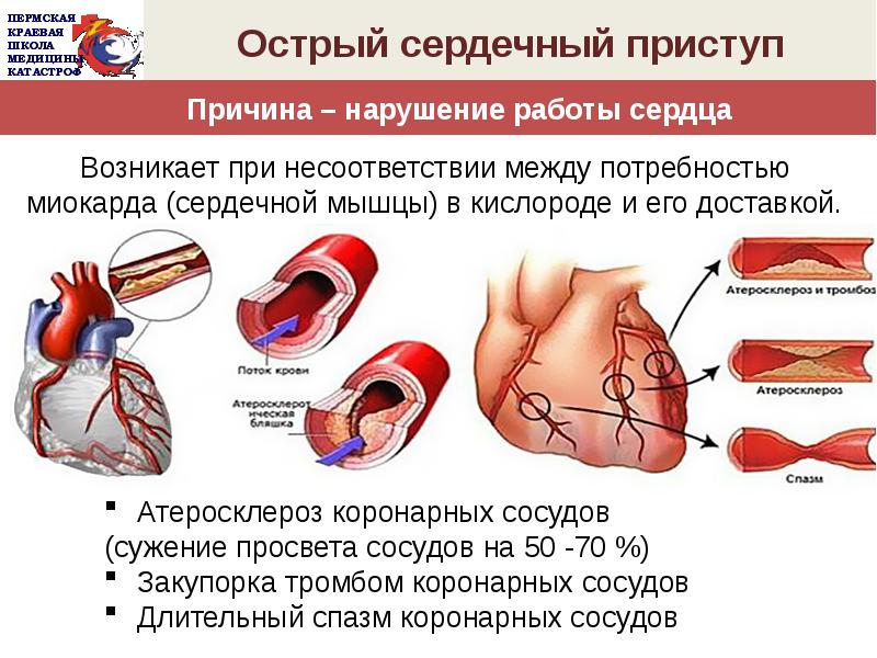 Часто сердечный. Сердечный приступ. Причины сердечного приступа. Сердечный приступ сердце. Атеросклероз коронарных артерий.