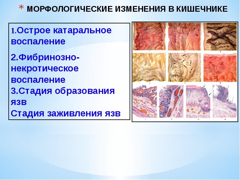 Шигеллез презентация инфекционные болезни