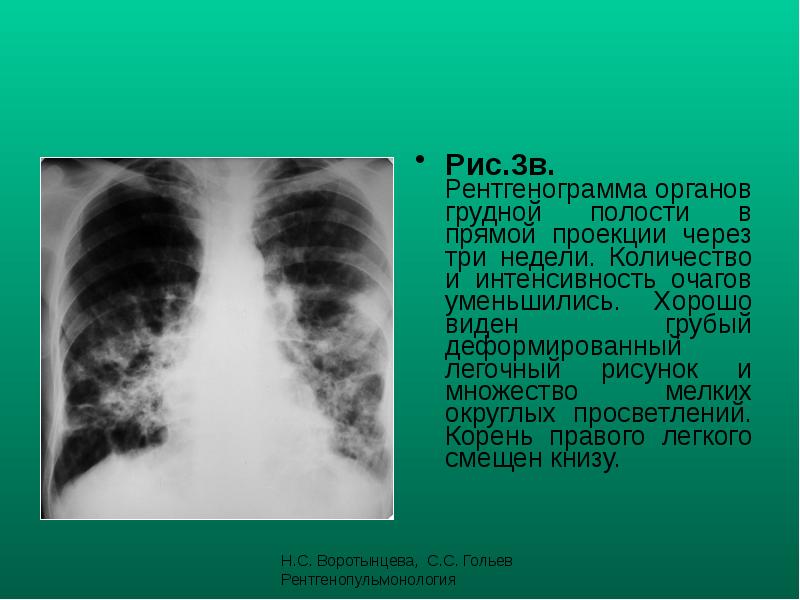 Легочный рисунок петлисто ячеисто деформирован