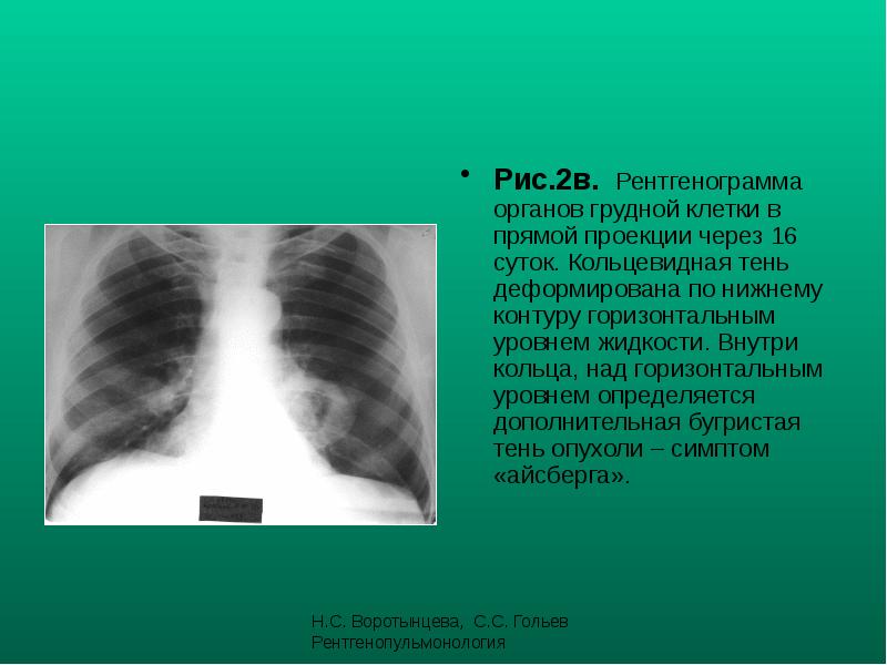 Деформация легочного рисунка тяжистые тени на рентгенограмме характерны для