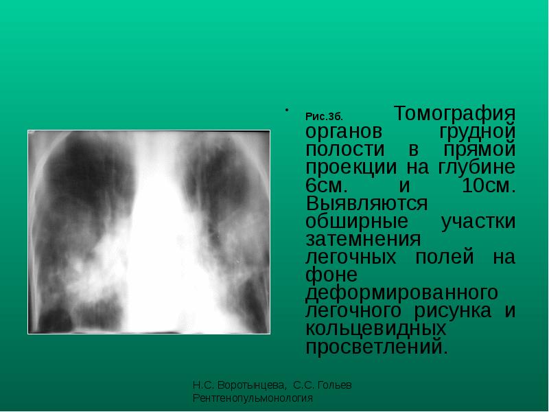 Обширное затемнение. Обширное затемнение легочного поля. Просветление легочного рисунка. Синдром кольцевидной тени на рентгенограмме.