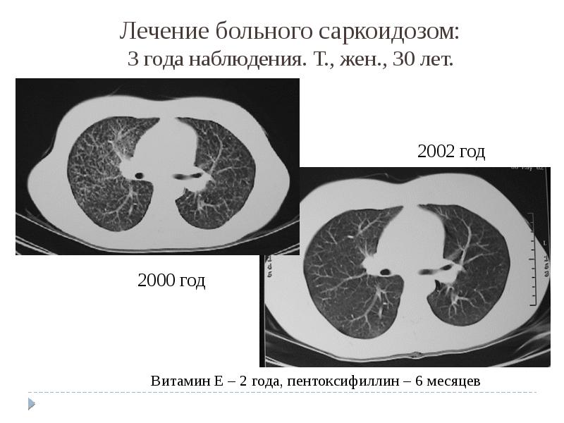 Саркоидоз 3. Классификация саркоидоза. Высыпания при саркоидозе.