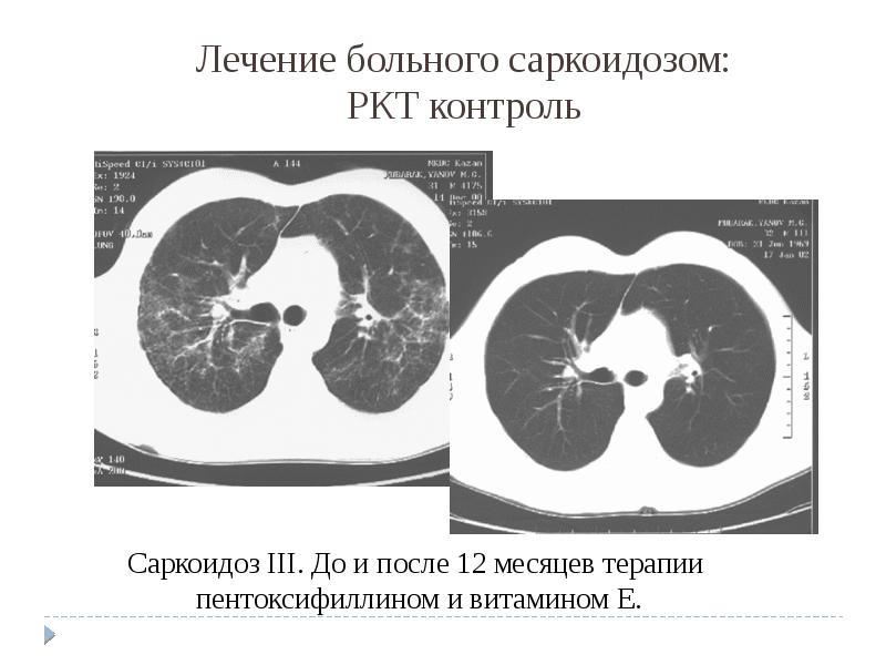 Саркоидоз легких презентация