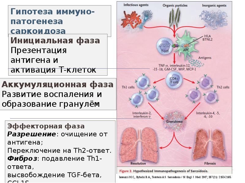 Схема лечения саркоидоза