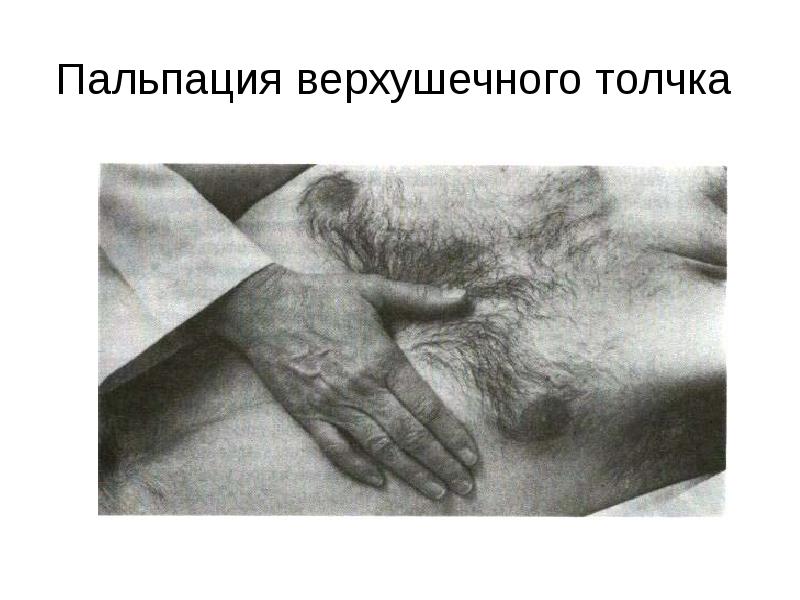 Пальпация верхушечного толчка