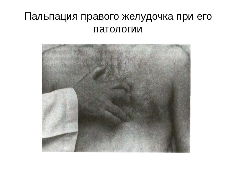 Пальпация правого желудочка при его патологии