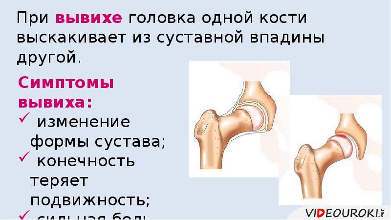 Презентация первая помощь при ушибах растяжениях вывихах и переломах