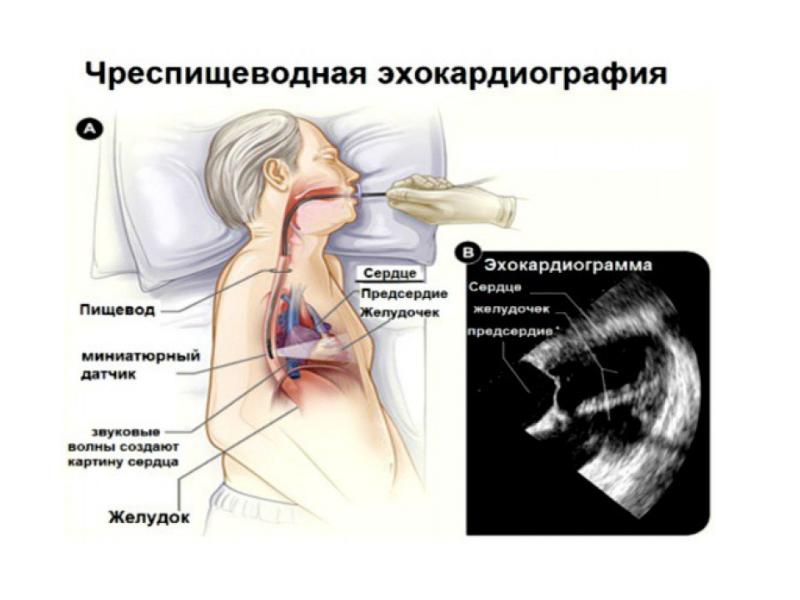 Чреспищеводная эхокардиография презентация