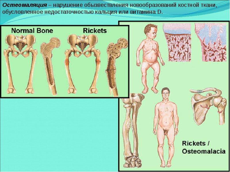 Д развитие. Остеомаляция (размягчение костей). Остеомаляция проявления. Симптомы остеомаляции у детей.