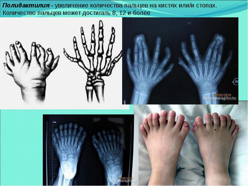 Аномалии развития верхних конечностей презентация