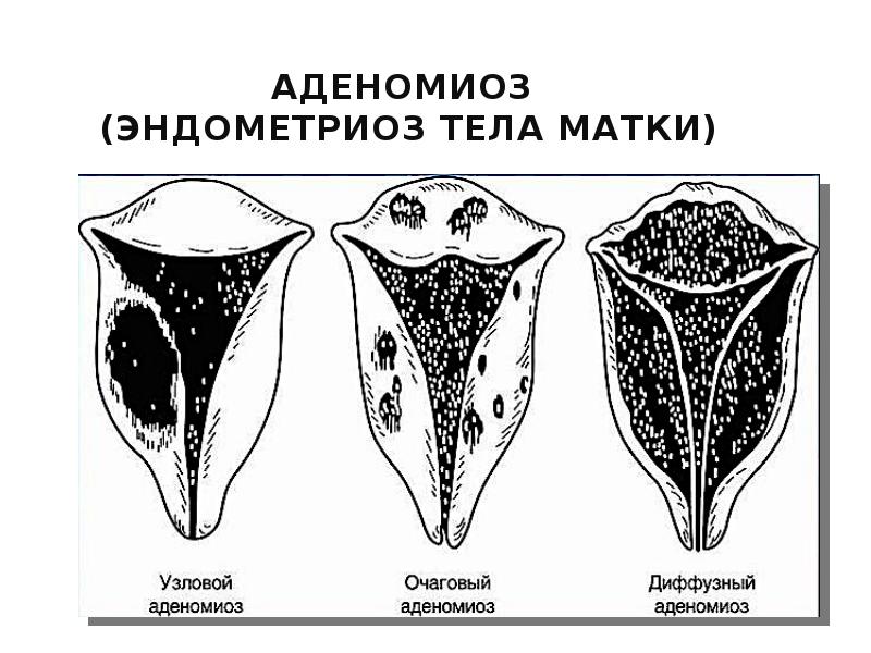 Диффузная форма матки. Аденомиоз и эндометриоз. Аденомиоз Узловая форма. Эндометриоз тела матки (аденомиоз). Очаговая форма эндометриоза тела матки.