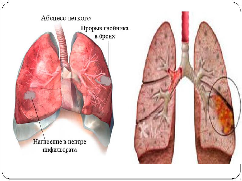 Плеврит легких картинки