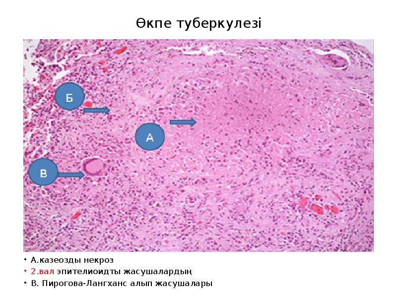 Өкпе туберкулезі презентация