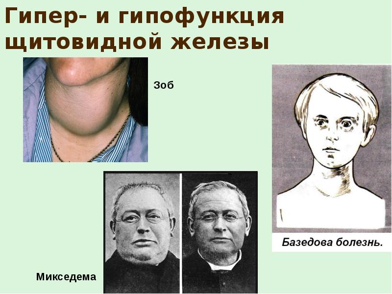 врожденный гипотиреоз кретинизм. при гипофункции щитовидной железы. гипофункция железы у взрослых. эффекты при гипофункции щитовидной железы. заболевания при гипофункции щитовидной железы.