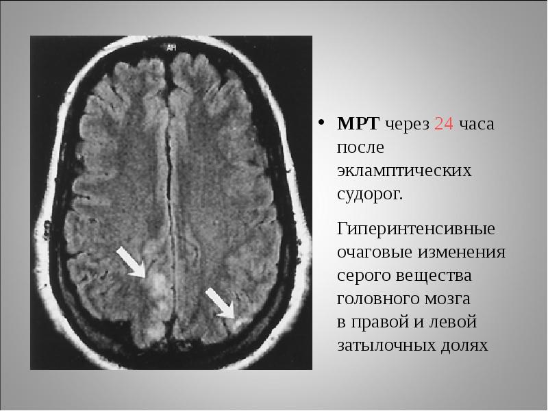 Мр картина очаговых изменений вещества головного мозга