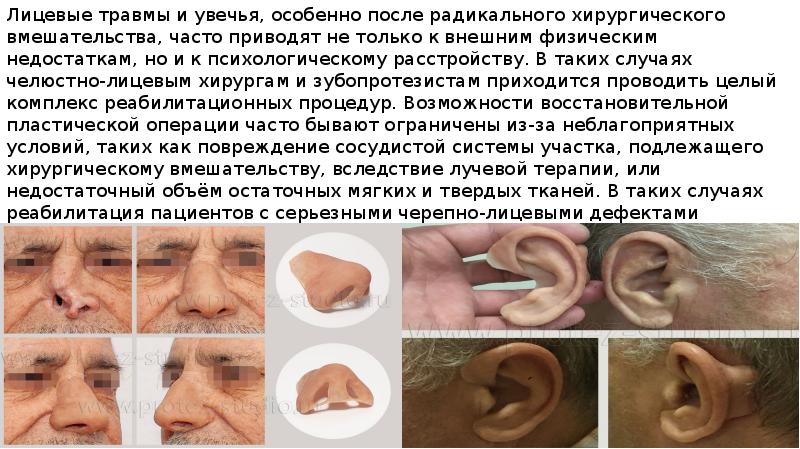 Лицевые травмы и увечья, особенно после радикального хирургического вмешательства, часто приводят