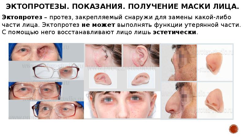 Эктопротезы. Показания. Получение маски лица. Эктопротез – протез, закрепляемый снаружи для