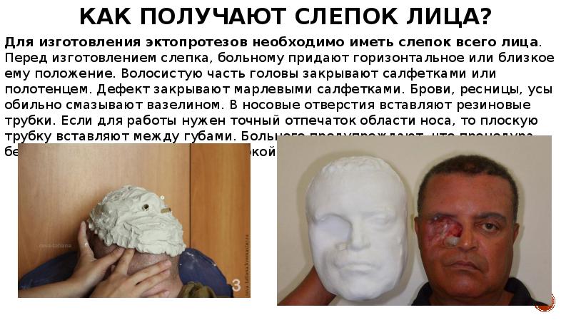 Как получают слепок лица? Для&nbsp;изготовления&nbsp;эктопротезов необходимо иметь слепок всего лица. Перед