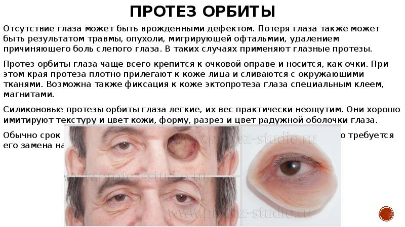 Протез орбиты Отсутствие глаза может быть врожденными дефектом. Потеря глаза также