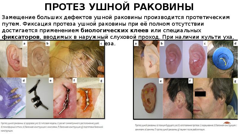 Протез ушной раковины Замещение больших дефектов ушной раковины производится протетическим путем.