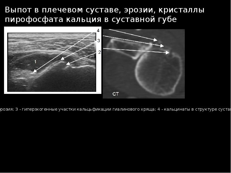 Узи суставов презентация