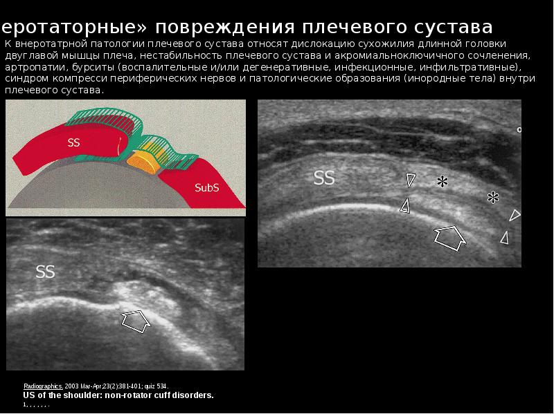 Протокол узи плечевого сустава образец