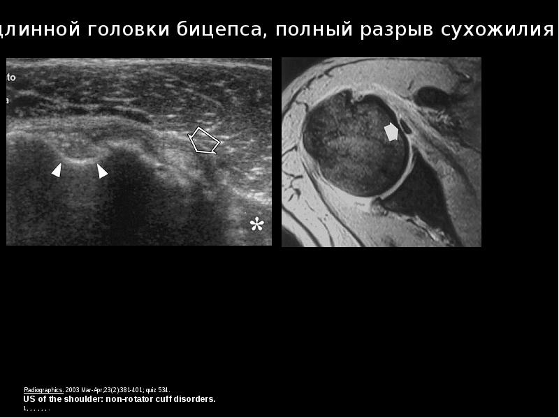 Образец протокола узи плечевого сустава