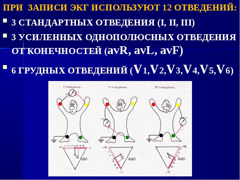 Картинка стандартные отведения