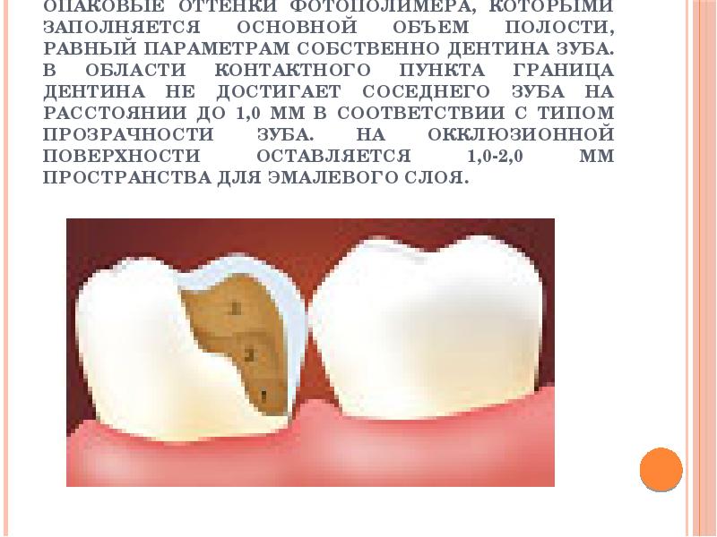 Кариес дентина презентация