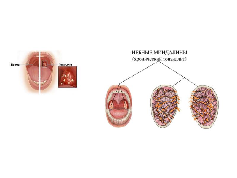 Декомпенсированный тонзиллит. Хронический тонзиллит воспаление миндалин. Небные миндалины тонзиллит. Тонзиллолиты хронический тонзиллит. Хроническое воспаление трубных миндалин.