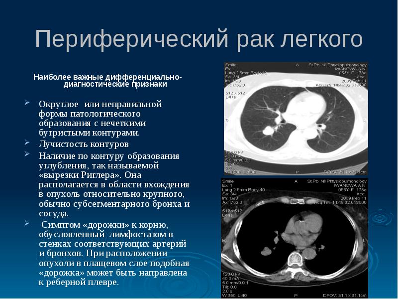 Схема диагностических мероприятий при наличии опухоли в легком