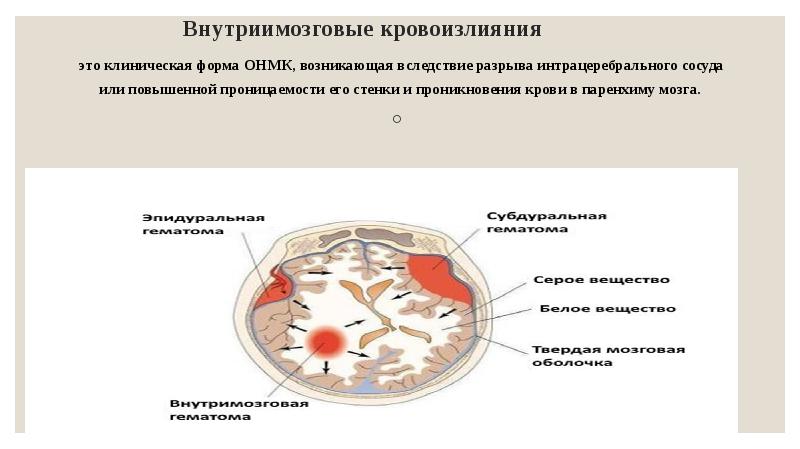 Геморрагический инсульт неврология презентация