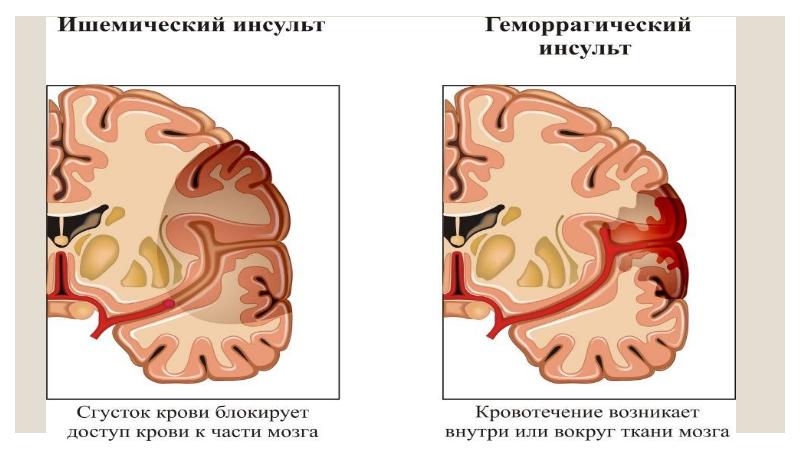 Геморрагический инсульт презентация