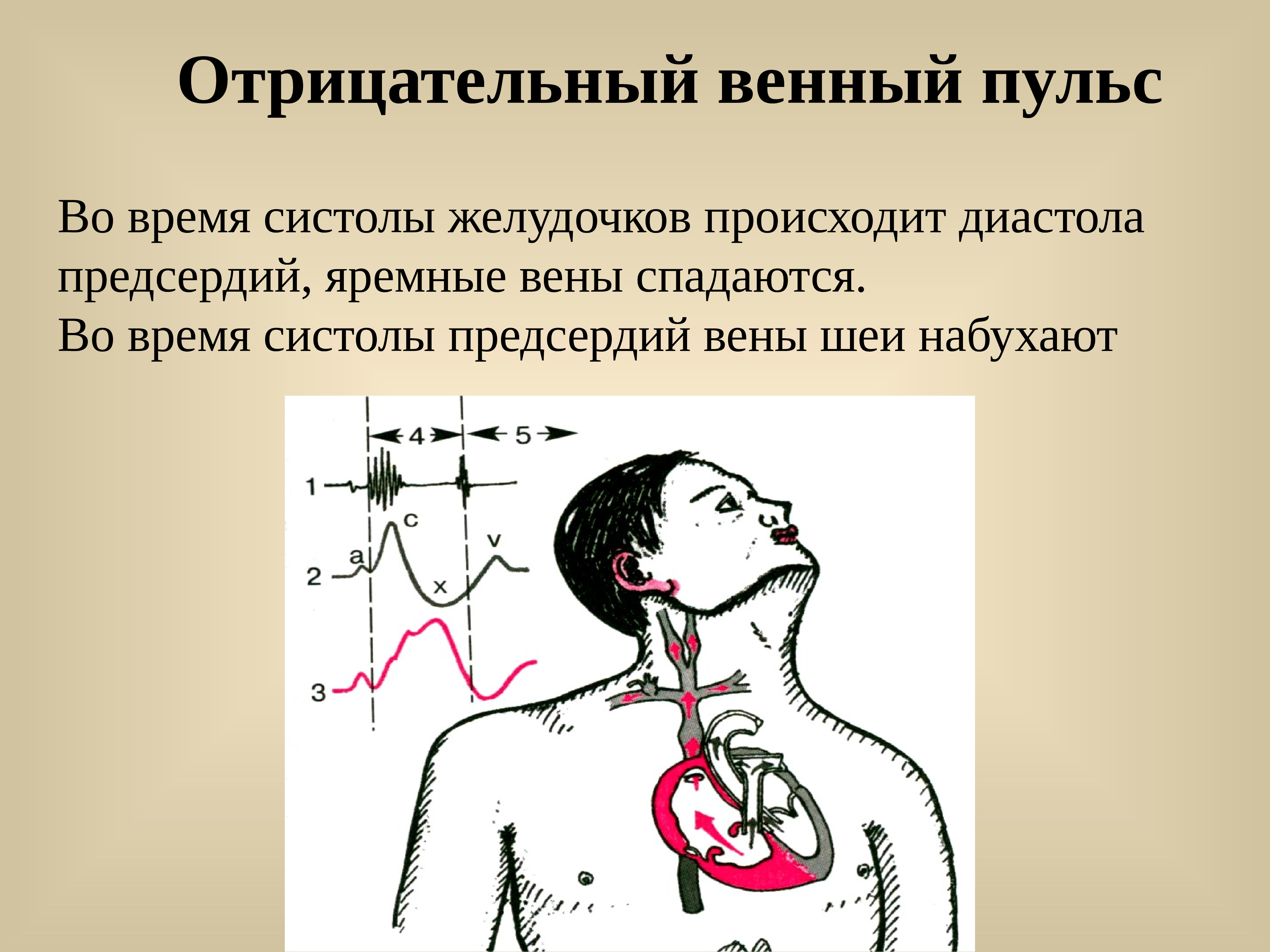 Г венный. Отрицательный венный пульс. Положительный венный пульс. Положительный и отрицательный венный пульс. Положительный венный пульс характерен для.