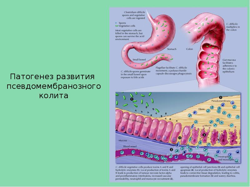 Псевдомембранозный колит симптомы на фоне антибиотиков