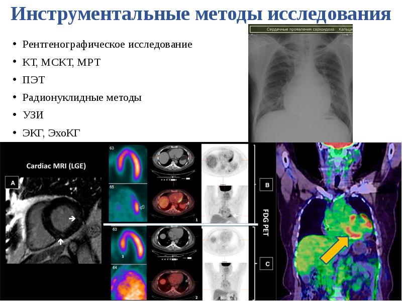 Саркоидоз лимфатических узлов кт.