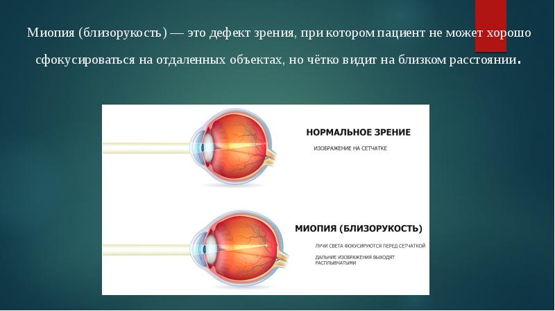 Презентация по теме миопия